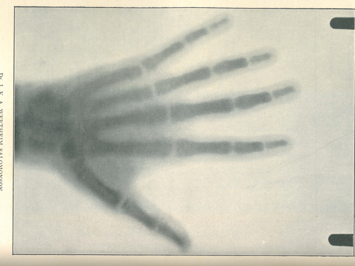 Nadat Wilhelm Röntgen (1845-1923) eind 1895 de x-stralen had ontdekt, liet Wertheim Salomonson onmiddellijk een kathodestraal­buis bouwen en publiceerde hij binnen enkele maanden de eerste röntgenfoto in het NTvG.  Een opname duurde toen tussen de 10-40 min, afhankelijk van het lichaamsdeel.